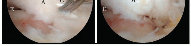 Illustration 22 for Posterior Talar Process: Endoscopic Solutions for Ankle Pain