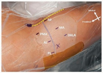 Illustration 12 for Beyond Knee Surg: Hip Arthroscopy for Sports Injuries