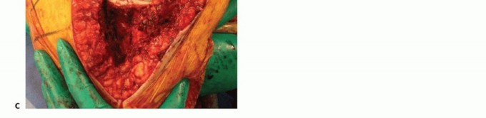 Illustration 22 for Femoral Bone Loss: Metal Augments for Revision Knee Success