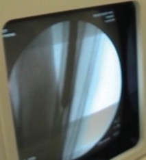 Illustration 19 for Arthrodesis with an Intramedullary Nail: Fixing Failed TKAs