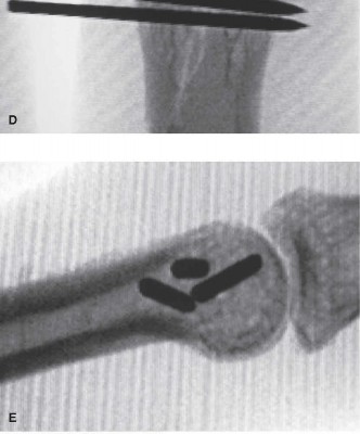 Illustration 3 for Proximal Phalanx Fracture: What's the Best Treatment?