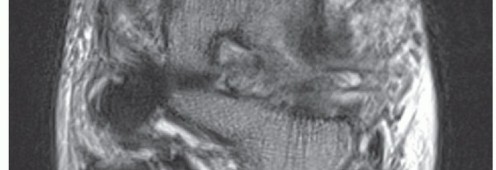 Illustration 10 for Medial Ankle Instability: Find Relief with Reconstruction