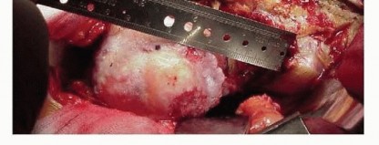 Illustration 8 for Cemented Total Hip: A Successful & Evidence-Based Solution