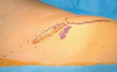 Unlock Your Hips: Adductor & Iliopsoas Release for Anterior Pelvic Tilt