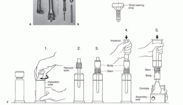 Illustration 5 for Distal Femoral Replacement: Key to Modern Limb Salvage