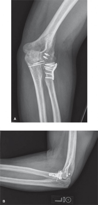 Illustration 3 for Terrible Triad Injury: Expert Guide to Diagnosis & Treatment