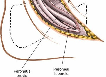 Illustration 123 for Optimized Approaches to the Dorsum of the Foot & Ankle