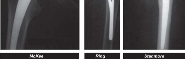 Illustration 14 for Mastering Hip Arthroplasty: Its Evolution and Design Unveiled