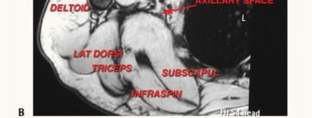 Illustration 4 for Axillary Space Exploration: Surgical Resection of Complex Tumors