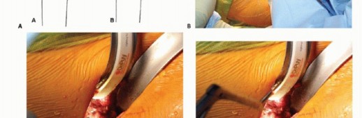 Illustration 20 for Anterior FAI Relief: Mini-Open Anterior Approach Explained