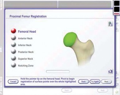 Illustration 34 for Minimizing Risks: Computer Navigation in Hip Resurfacing Arthroplasty
