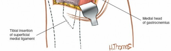 Illustration 75 for Mastering Knee Approaches: Spotlight on Superficial Medial Ligament