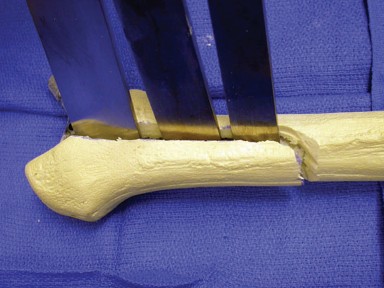 Illustration 22 for Achieving Success with Trochanteric Osteotomy Posterior for Revision