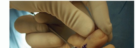 Illustration 29 for Hammer Toe Correction: Understanding the Extensor Digitorum Longus