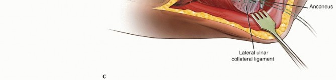 Illustration 23 for Radial Head Arthroplasty: Restoring Elbow Function & Stability