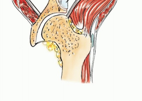Illustration 45 for Pelvic Metastasis Surgery: A Component of the Utilitarian Approach