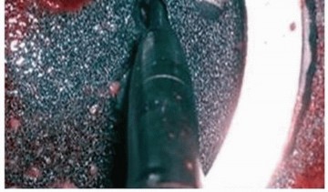 Illustration 11 for Uncemented Acetabular Component: Augments & Cup-Cages for Bone Loss