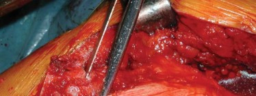 Illustration 57 for S-ROM: Inside the Technique of Modular Implant Design