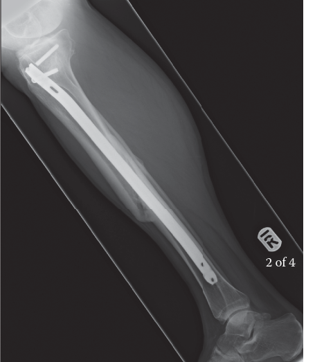 Illustration 2 for Nonunion Fractures: Signs, Diagnosis, and What to Know