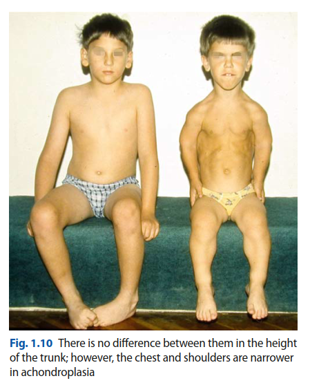 Orthopedic Cases Achondroplasia: Essential Insights & Management