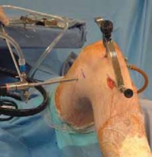 Illustration 11 for Cruciate Ligament Repair: Definitive Guide to Treatment & Recovery