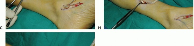 Illustration 29 for Restore Movement: Tendon Transfer for Common Peroneal Nerve Foot Drop