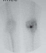 Illustration 16 for Guide Pin Assembly: Key to Flawless Upper Tibial Osteotomy