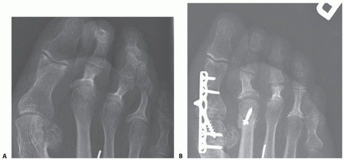 Illustration 3 for Toe Deformity Pain? Rebalance Flexor to Extensor for Relief
