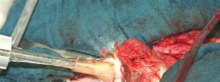 Illustration 46 for Optimizing Infected THA: The One Staged Approach Explained