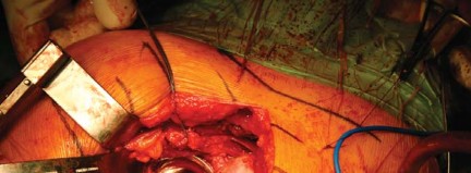 Illustration 38 for Metal on Metal Resurfacing: Enhanced Posterior Soft Tissue Repair