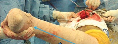 صورة طبية: إتقان توازن الأنسجة الرخوة لمفصل ورك صناعي مثالي: دليل شامل للمرضى مع الأستاذ الدكتور محمد هطيف