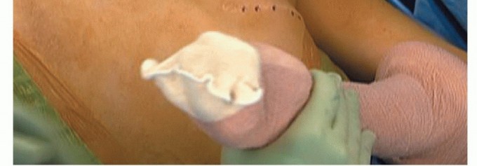 Illustration 13 for Is Your Dorsal Scapular Nerve Causing Snapping Scapula Pain?