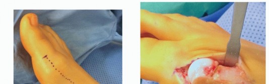 Masterclass in the Scarf Osteotomy: Biomechanics, Technique, and Outcomes