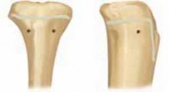Illustration 11 for Pediatric Tibial Fractures: Avoid Mistakes, Ensure Optimal Healing