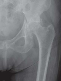 Illustration 14 for Navigating Early THA for Fractures of the Acetabulum