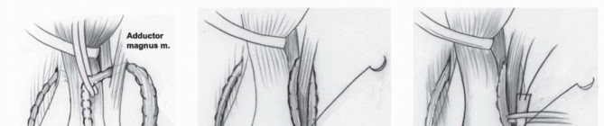 Illustration 39 for Treatment for Congenital Femoral Deficiency: What You Need to Know