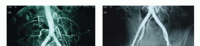 Illustration 20 for Sacral Tumor Surgery: Safeguarding Bowel & Bladder Control