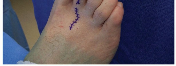 Illustration 14 for Hammer Toe Correction: Understanding the Extensor Digitorum Longus