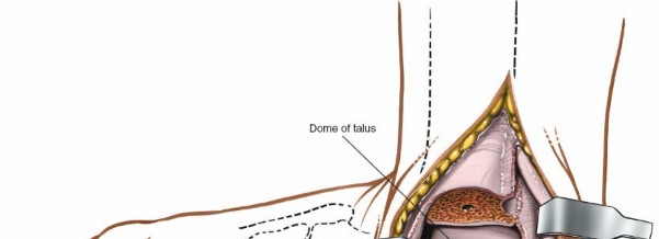 Illustration 11 for Step-by-Step Medial Side of the Ankle Approach Guide