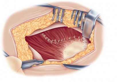 Illustration 65 for Direct Lateral Hip: Optimize Exposure with Sharp Curved Hohmann