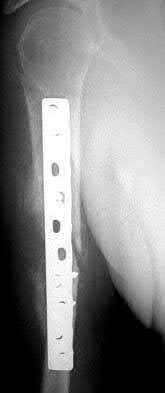 Illustration 91 for OrthoCash: Trauma MCQs & Cases for a yearold woman