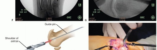 Illustration 20 for End Articular Cartilage Loss: Arthrosurface HemiCAP Resurfacing