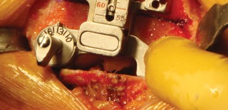 Illustration 19 for Cemented TKA Figure: Your Visual Guide to Surgical Success