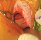 Illustration of adductorrelated groin pain - Dr. Mohammed Hutaif