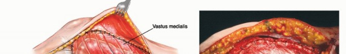Illustration 51 for Mastering Femoral Metastases: Optimal Function for Femoris & Vastus