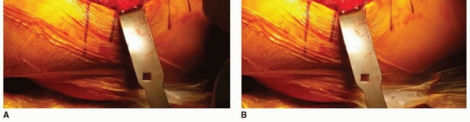 Illustration 10 for The Tapered Stem: Your Guide to Durable Cementless Hip Fixation