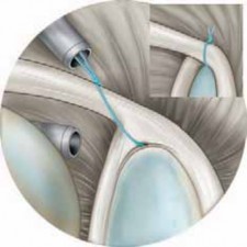 End Shoulder Pain: Arthroscopic Treatment for Superior Labral SLAP Tears