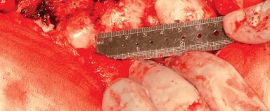 Illustration 9 for Posterolateral Surgical Approaches: Achieve Optimal Hip Replacement