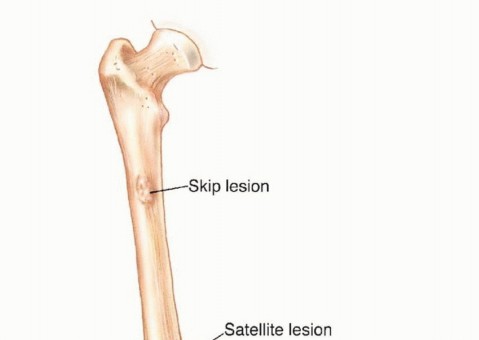 Illustration 4 for Precision Biopsy of Musculoskeletal Tumors for Accurate Diagnosis