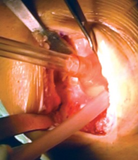Illustration 27 for Cemented TKA Figure: Your Visual Guide to Surgical Success